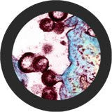 HIV / AIDS / Ihmisen immuunikatovirus jättiläismikrobit