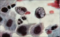 Klamydia / Chlamydia (Chlamydia trachomatis) - halkaisija noin 40 cm