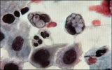 Klamydia / Chlamydia (Chlamydia trachomatis) - halkaisija noin 40 cm